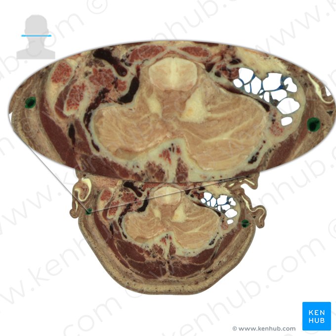 Veia auricular posterior (Vena auricularis posterior); Imagem: National Library of Medicine