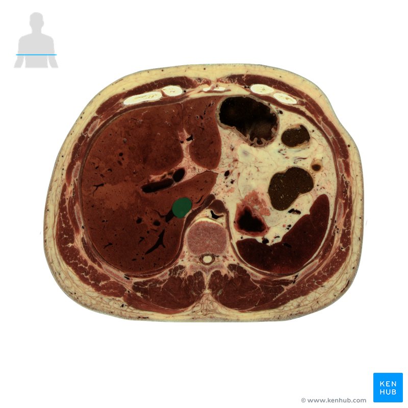 Inferior vena cava - axial view