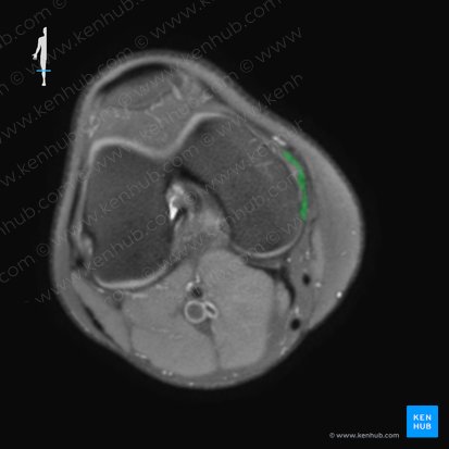 Ligamento colateral tibial de la articulación de la rodilla (Ligamentum collaterale tibiale genus); Imagen: 