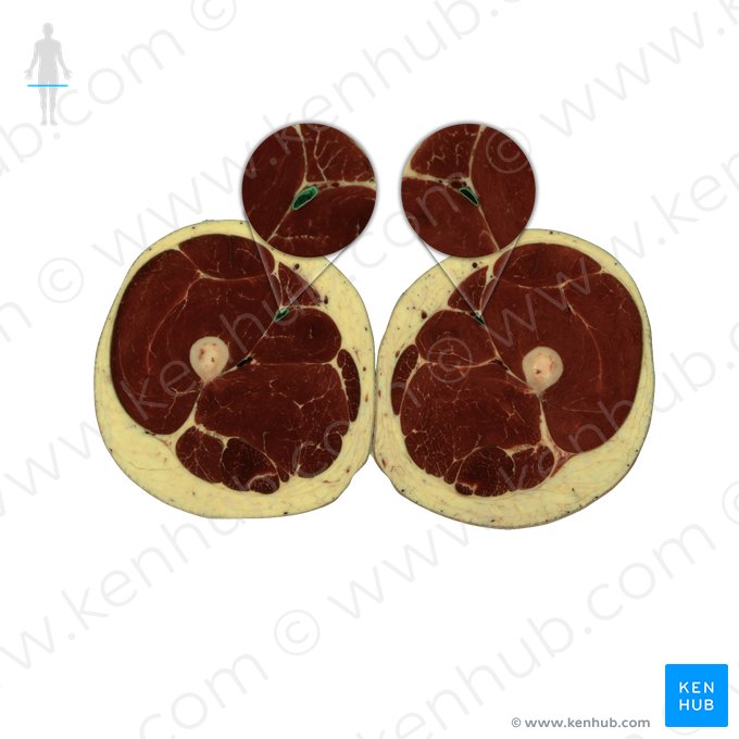 Veia femoral (Vena femoralis); Imagem: National Library of Medicine