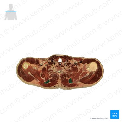 Rhomboid minor muscle (Musculus rhomboideus minor); Image: National Library of Medicine