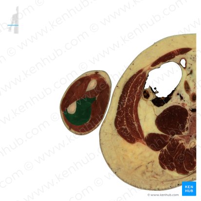 Músculo flexor profundo dos dedos (Musculus flexor digitorum profundus); Imagem: National Library of Medicine