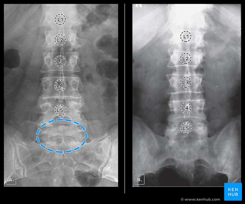 S1 lumbarization