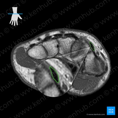 Vagina tendinis musculi extensoris carpi radialis longus (Sehnenscheide des langen speichenseitigen Handstreckers); Bild: 