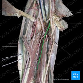 Nervio interóseo antebraquial anterior (Nervus interosseous anterior); Imagen: 