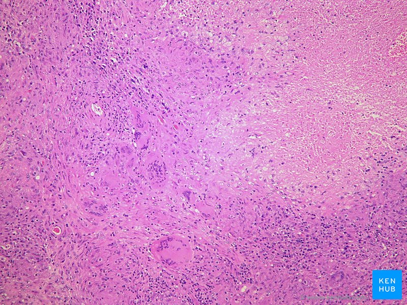 Pulmonary tuberculosis - necrotizing granuloma