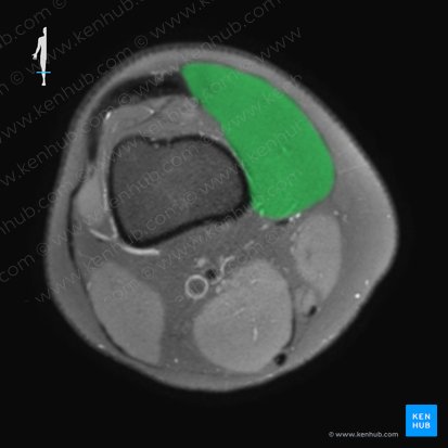 Músculo vasto medial (Musculus vastus medialis); Imagen: 