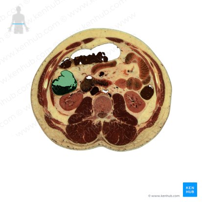 Ascending colon (Colon ascendens); Image: National Library of Medicine