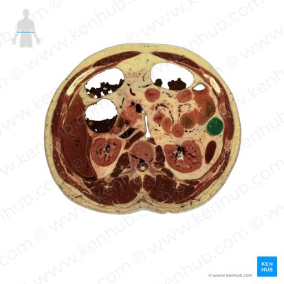 Colon descendens (Absteigender Dickdarm); Bild: National Library of Medicine