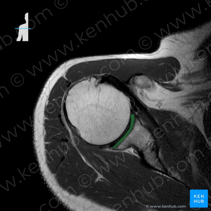 Cavidade glenoide da escápula (Fossa glenoidalis scapulae); Imagem: 