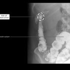 Clinical case: Large bowel obstruction as a delayed complication of pancreatitis