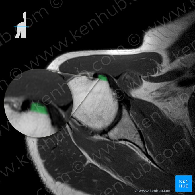 Tubérculo menor del húmero (Tuberculum minus humeri); Imagen: 