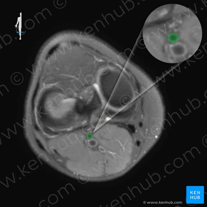 Popliteal artery (Arteria poplitea); Image: 