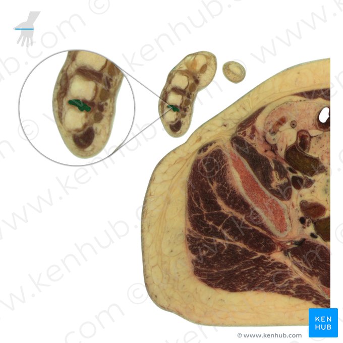 4.º músculo interósseo dorsal da mão (Musculus interosseus dorsalis 4 manus); Imagem: National Library of Medicine