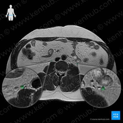 Vena testicularis (Hodenvene); Bild: 