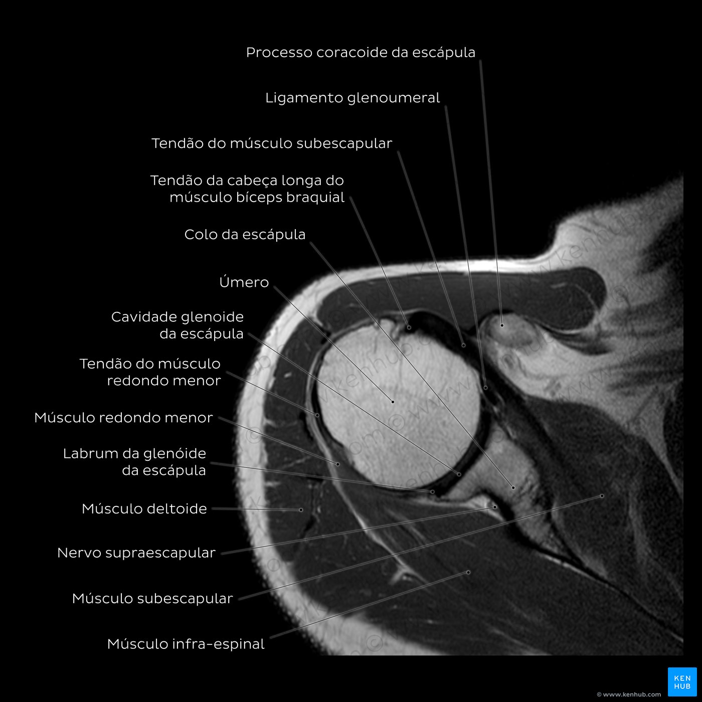 Esquema de RM em PD de ombro ao nível da cavidade glenoidal