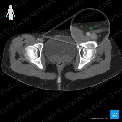 Superficial inguinal lymph nodes (Nodi lymphoidei inguinales superficiales); Image: 