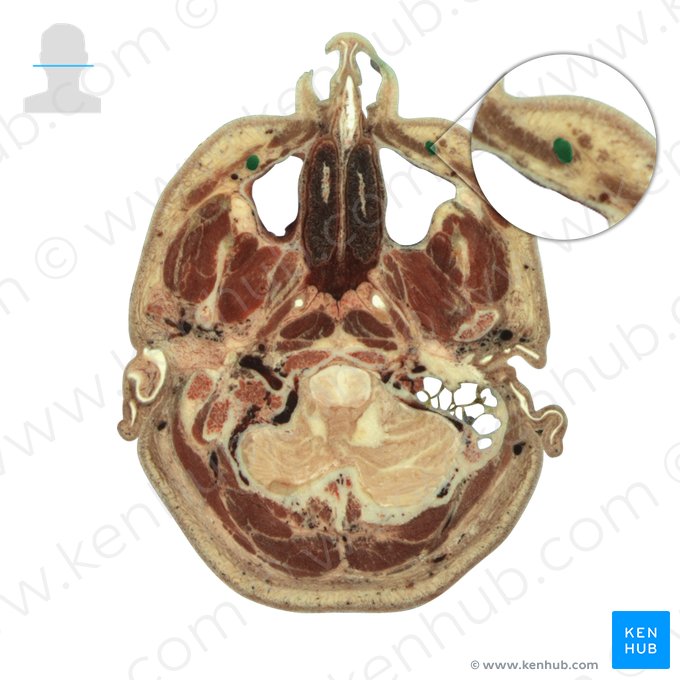 Facial vein (Vena facialis); Image: National Library of Medicine