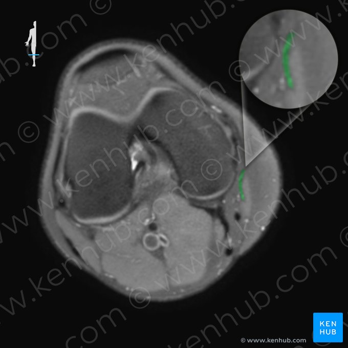 Tendon of sartorius muscle (Tendo musculi sartorii); Image: 