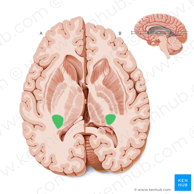 Porción retrolenticular de la cápsula interna (Pars retrolentiformis capsulae internae); Imagen: Paul Kim