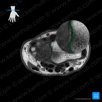 Ulnar notch of radius (Incisura ulnaris radii); Image: 