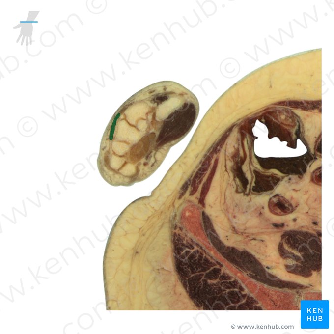 Tendons of extensor digitorum muscle (Tendines musculi extensoris digitorum); Image: National Library of Medicine