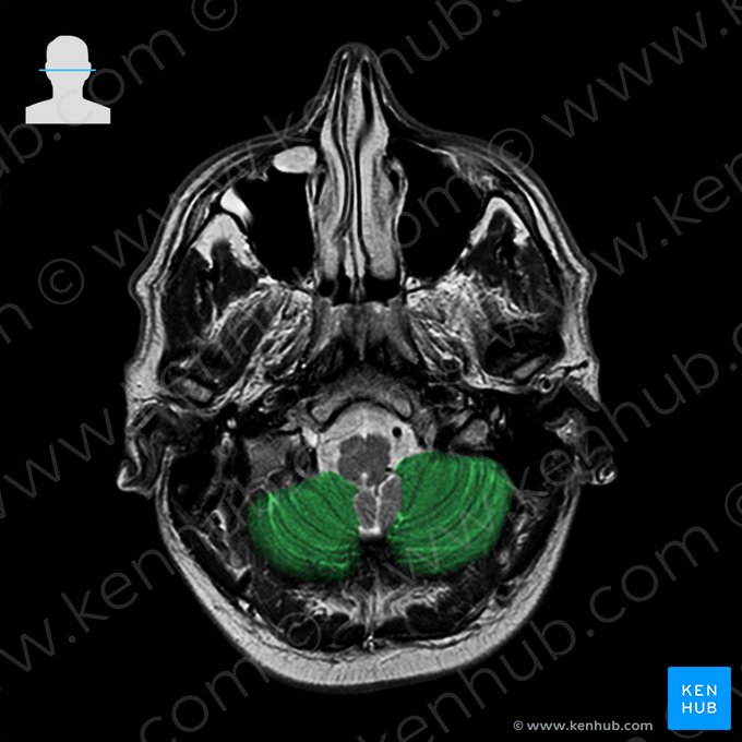 Lóbulo posterior del cerebelo (Lobus posterior cerebelli); Imagen: 