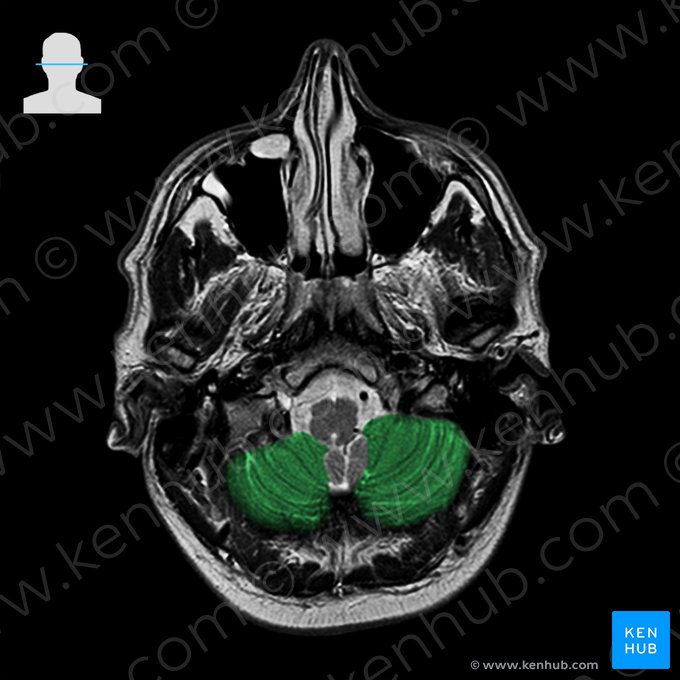 Lobus posterior cerebelli (Hinterer Lappen des Kleinhirns); Bild: 