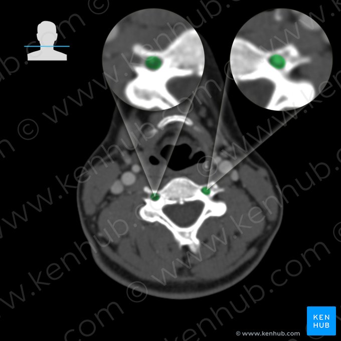 Vertebral artery (Arteria vertebralis); Image: 