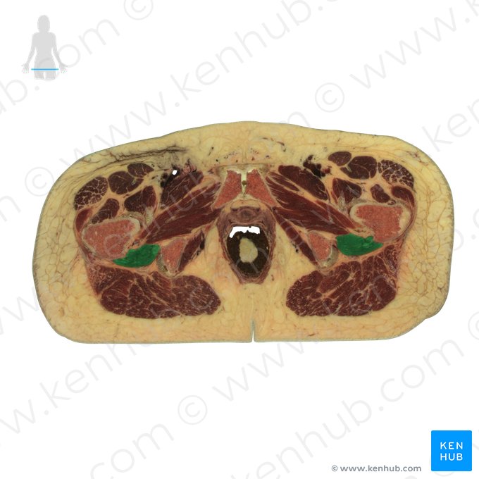 Musculus quadratus femoris (Viereckiger Oberschenkelmuskel); Bild: National Library of Medicine