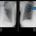 Clinical case: Giant first rib tumor