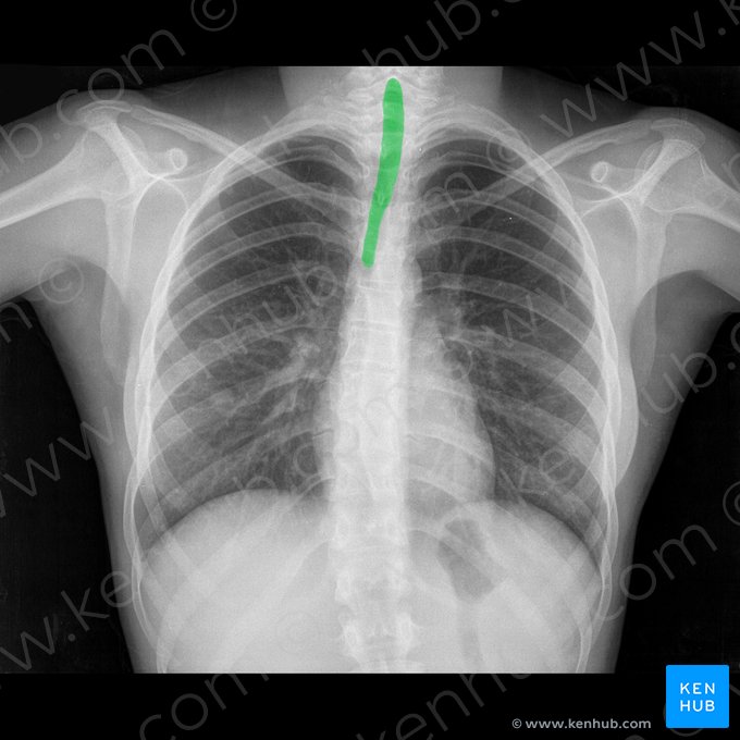 Traqueia (Trachea); Imagem: 