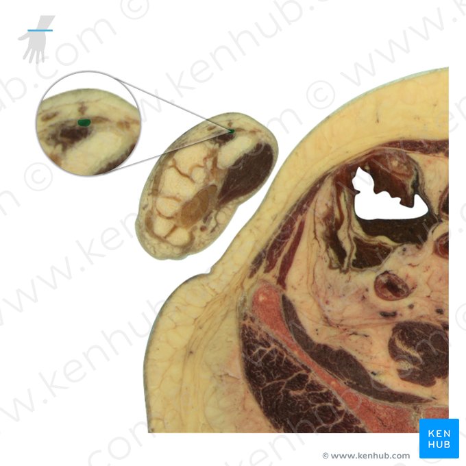 Tendo musculi extensoris pollicis longi (Sehne des langen Daumenstreckers); Bild: National Library of Medicine