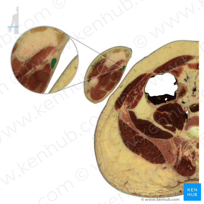 Flexor carpi radialis muscle (Musculus flexor carpi radialis); Image: National Library of Medicine