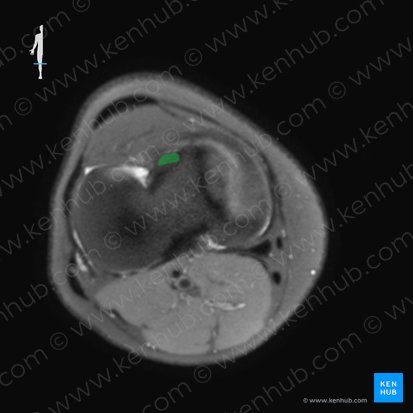 Anterior cruciate ligament (Ligamentum cruciatum anterius); Image: 