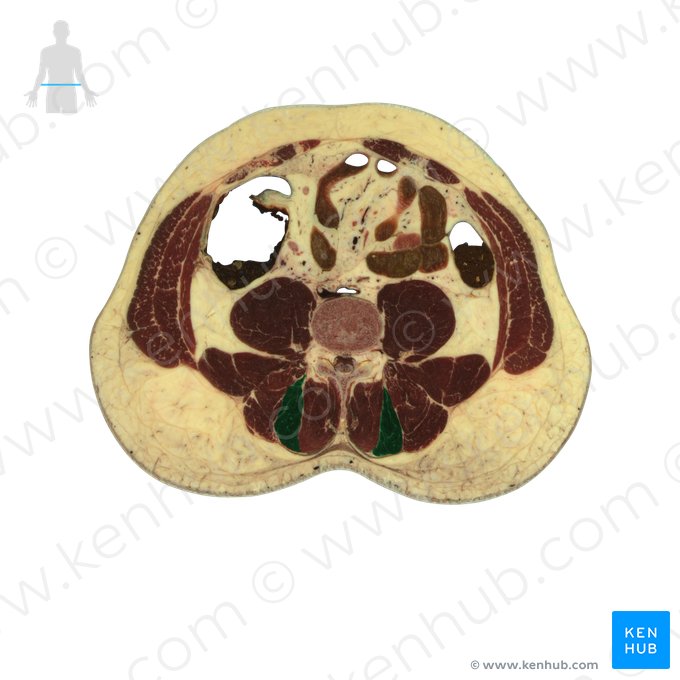 Musculus longissimus (Langer Rückenmuskel); Bild: National Library of Medicine