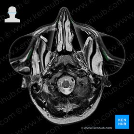 Nasalis muscle (Musculus nasalis); Image: 