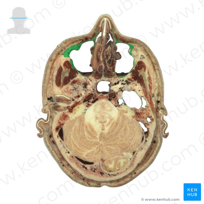 Maxila (Maxilla); Imagem: National Library of Medicine