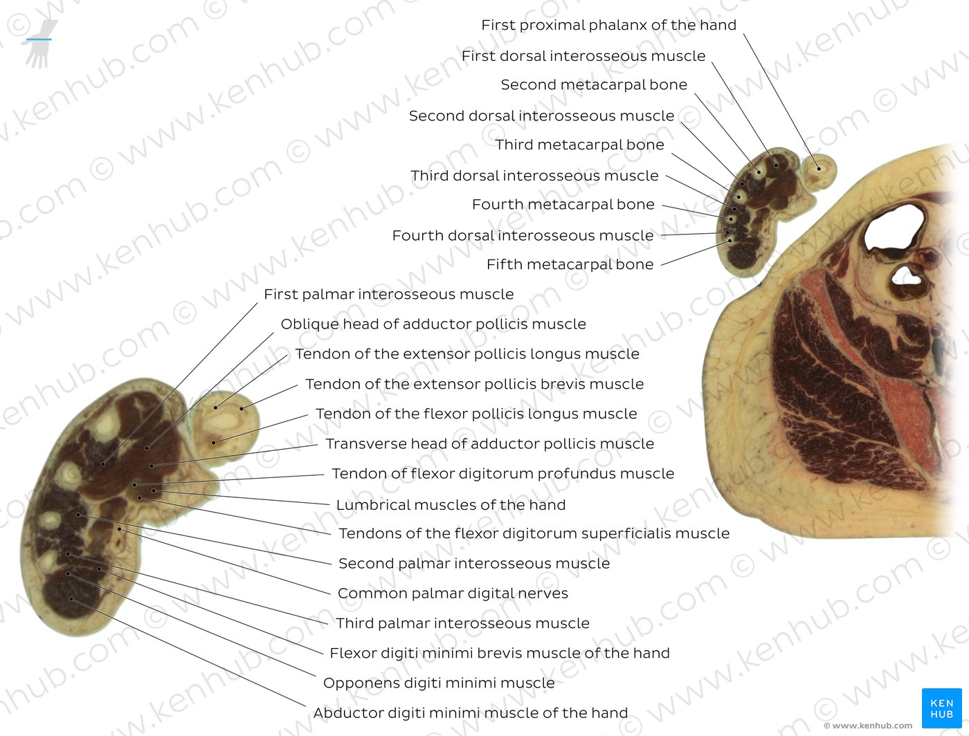 Hypothenar eminence level: Overview