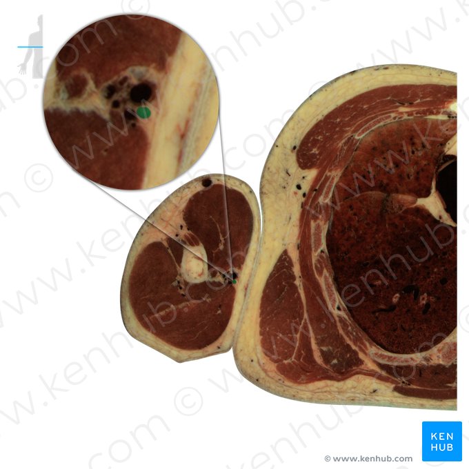 Nervo ulnar (Nervus ulnaris); Imagem: National Library of Medicine