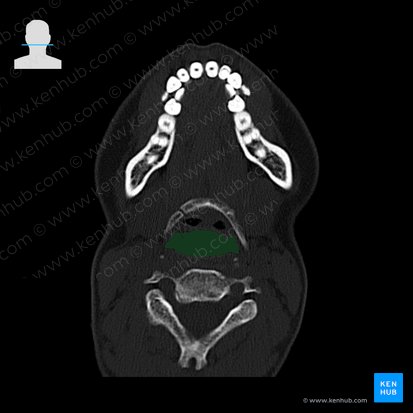 Laryngopharynx (Pars laryngea pharyngis); Image: 