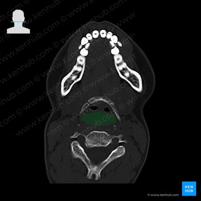 Laryngopharynx (Pars laryngea pharyngis); Image: 