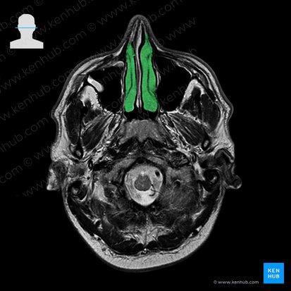 Concha nasal inferior (Concha nasalis inferior); Imagem: 