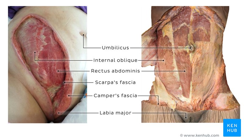 Fasciae of the abdominal wall in a cadaver and surgical debridement