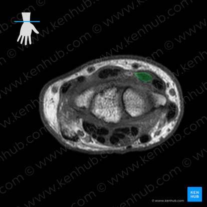 Tendon of extensor carpi radialis brevis muscle (Tendo musculi extensor carpi radialis brevis); Image: 