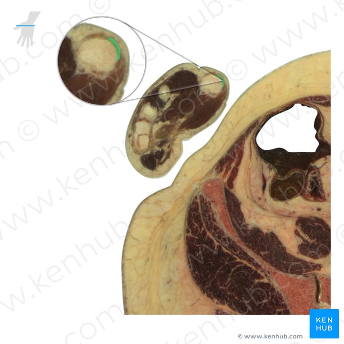 Tendon of extensor pollicis brevis muscle (Tendo musculi extensoris pollicis brevis); Image: National Library of Medicine