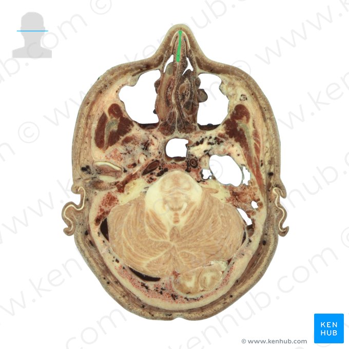 Cartilagem do septo nasal (Cartilago septi nasi); Imagem: National Library of Medicine