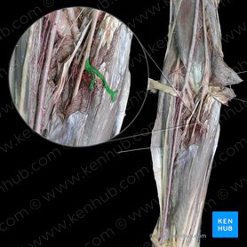 Ramos musculares do nervo mediano para o músculo flexor superficial dos dedos (Rami musculares nervi mediani cum musculus flexor digitorum superficialis); Imagem: 