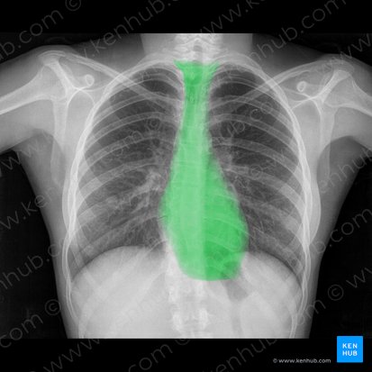 Mediastinum; Image: 