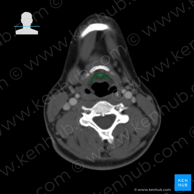 Corpo gorduroso pré-epiglótico (Corpus adiposum preepiglotticum); Imagem: 